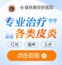長春治療皮膚病醫(yī)院咨詢神經(jīng)性皮炎怎么治療才能根除